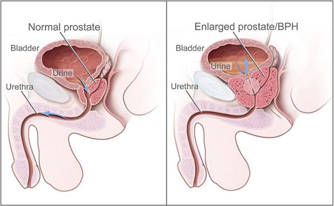 Two-panel drawing shows normal male reproductive and urinary anatomy 