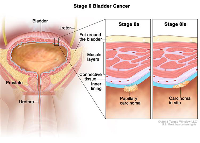 Stage 0