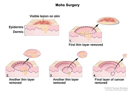 Mohs Surgery